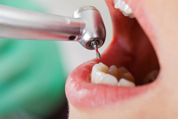 Best Emergency Dentist for Lost Fillings or Crowns in Inesville, GA